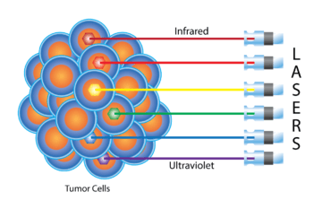 Diagram of light therapy using lasers to help kill cancer tumor cells