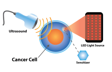 Diagram of Sono Photo Dynamic Therapy affecting cancer cells